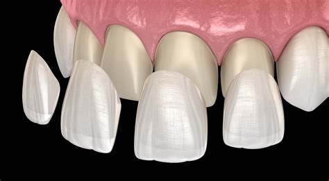 2018 peer reviewed articles best dental veneer bonding