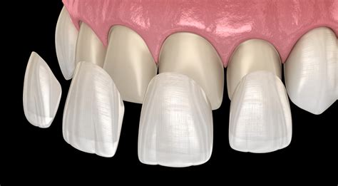 a dental hygienist can bond veneers except for provisionals