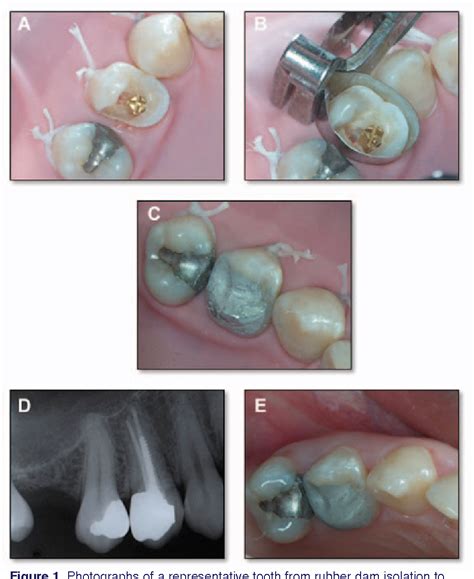 adhesively bonded versus non bonded amalgam restorations for dental caries