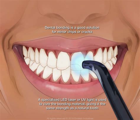 adjust dental bond