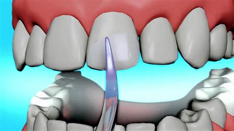 agua bond dental procedure xemax