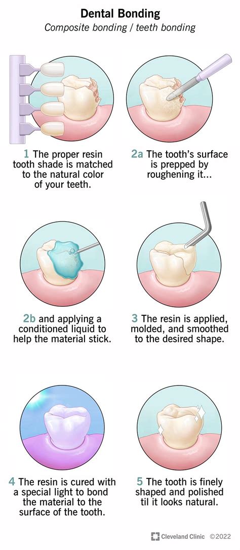 agua bond dental procedure