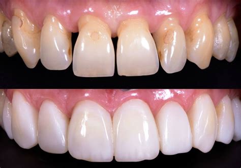 anterior bonding dental