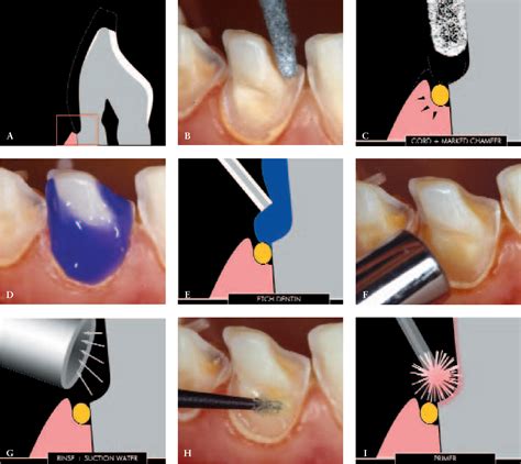 apex dental bond