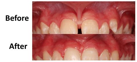 are frenectomy va dental bonding