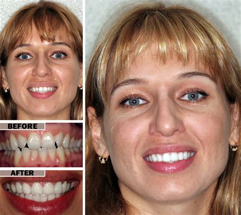 before and after pictures of dental bonding