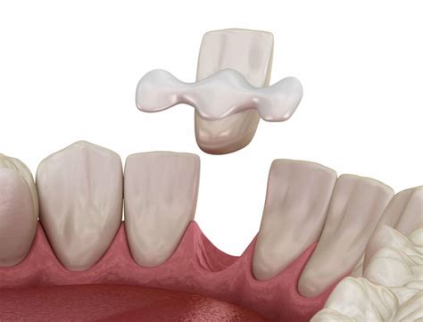 bonded dental bridge