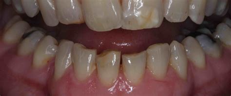 can dental bonding be removed