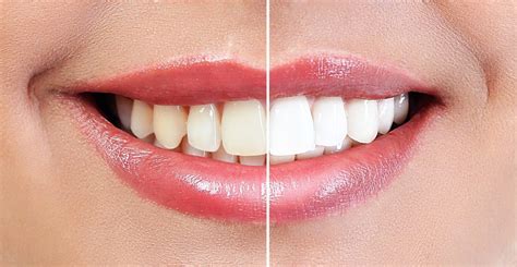 can dental bonding be whitened