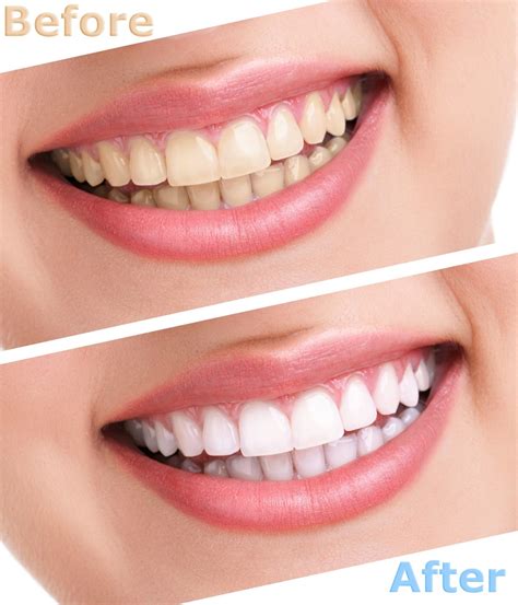 can you whiten dental bonding