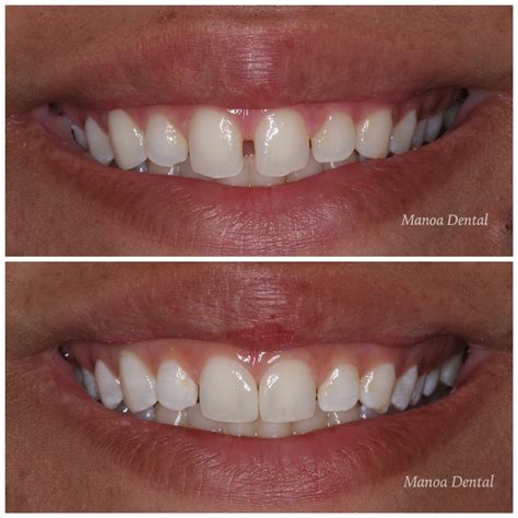 cosmetic dental bonding near me