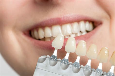 cost dental bonding vs veneers