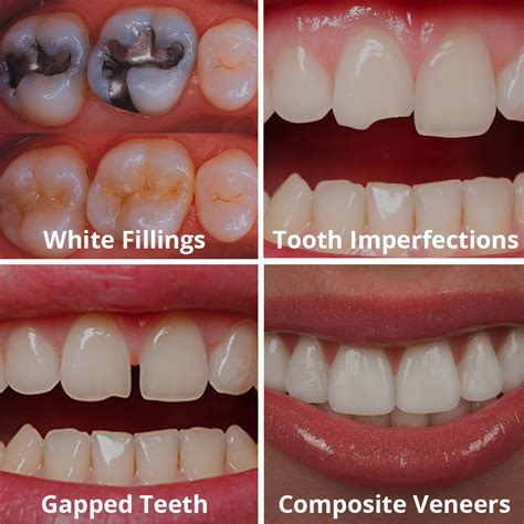 cost of dental bonding per tooth