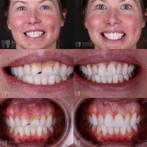 dental bonding before after