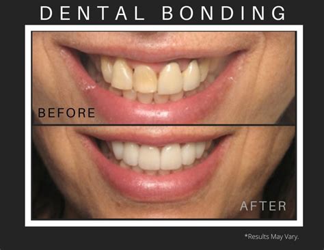 dental bonding before and after gap