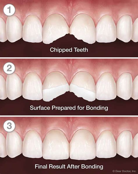 dental bonding chipped front tooth