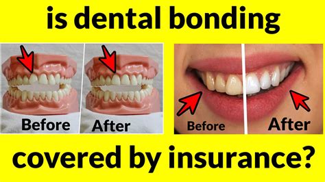 dental bonding covered by insurance