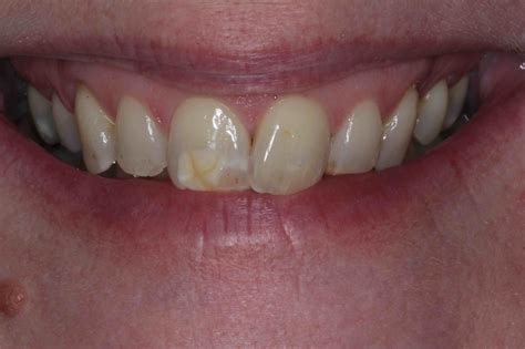 dental bonding discoloration