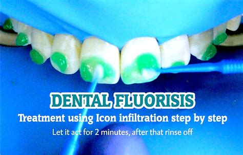 dental bonding for fluorosis