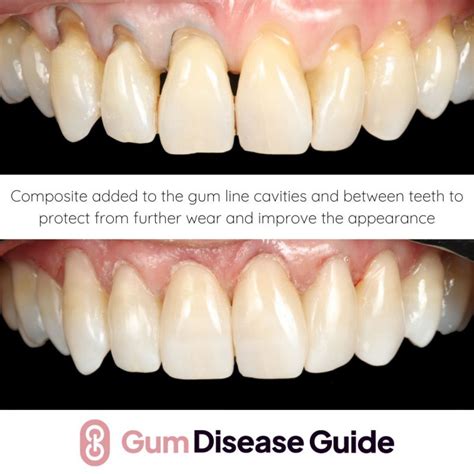 dental bonding for gum recession