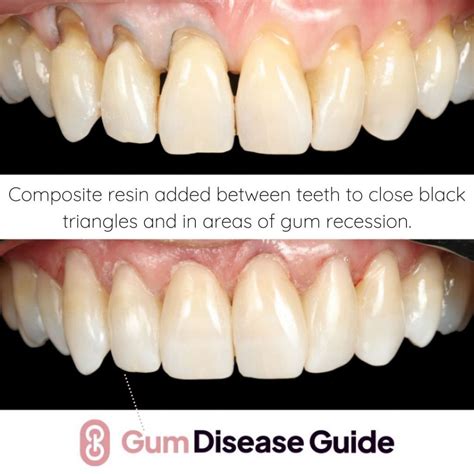 dental bonding for receding gums