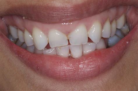 dental bonding front teeth before and after