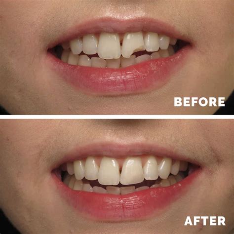 dental bonding front teeth cost