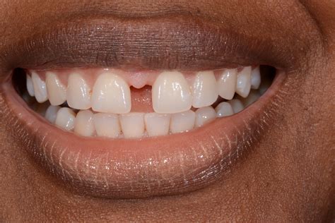 dental bonding front teeth gap