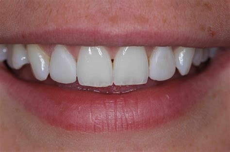 dental bonding front teeth