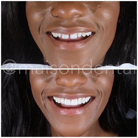 dental bonding gap before after