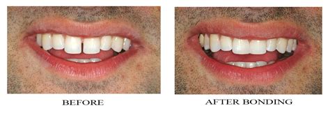 dental bonding gap teeth