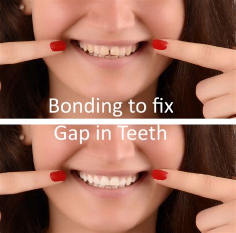 dental bonding gaps