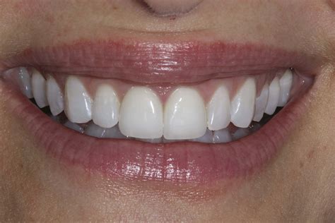 dental bonding or veneers