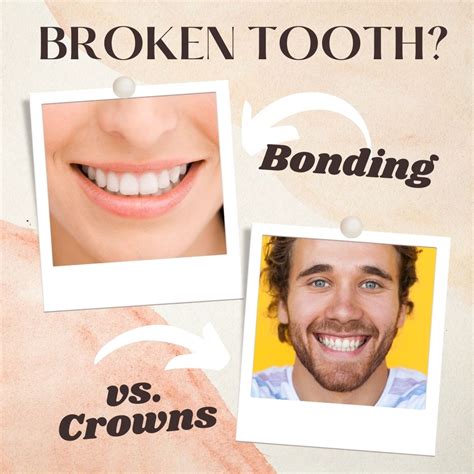 dental bonding vs crowns