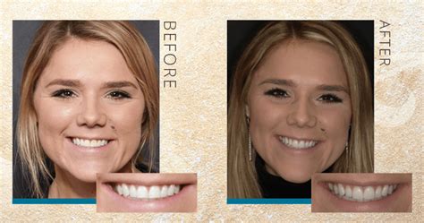 dental bonding vs veneer