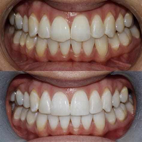 dental composite bonding before and after