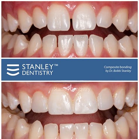 dental composite bonding near me