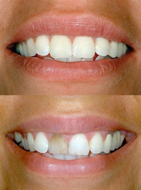 does dental bonding damage teeth