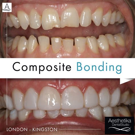 does dental insurance cover composite bonding