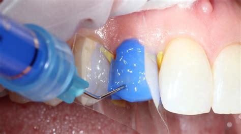 etching for dental bonding is done with