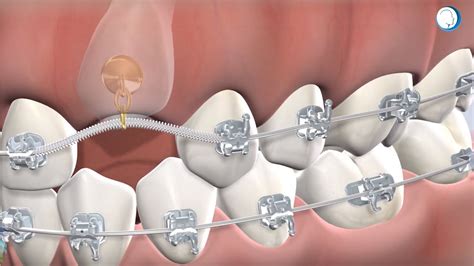 expose and bond dental code