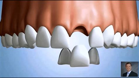 maryland bonded dental bridge