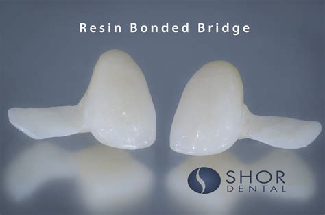 resin bonded dental bridge