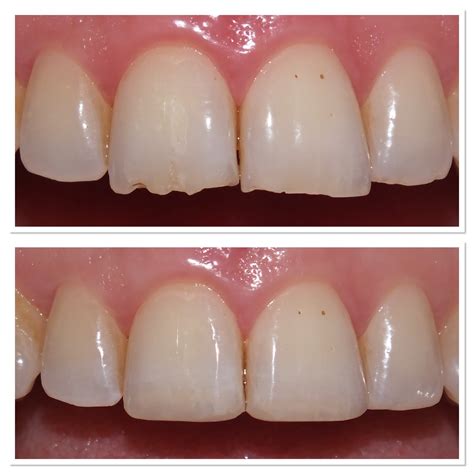 what is dental composite bonding